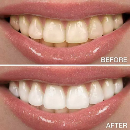 Carbón Coco® - Blanqueador Dental Acción Inmediata